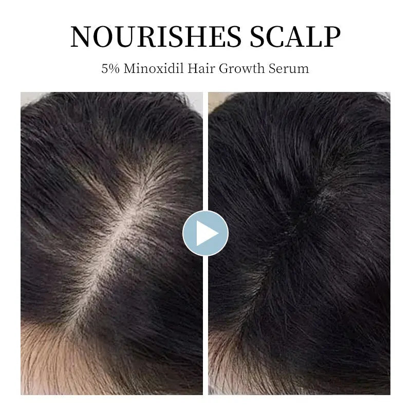 Tonique Capillaire Minoxidil Croissance Cheveux - BMYANY